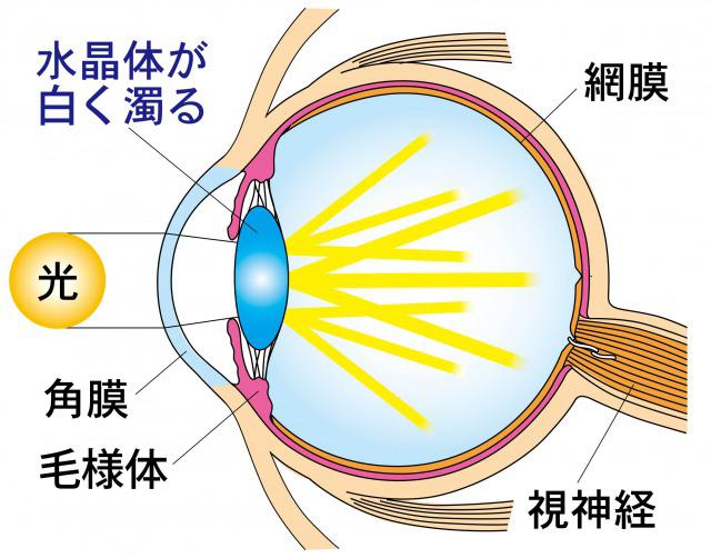 Diagram of cataract.jpg