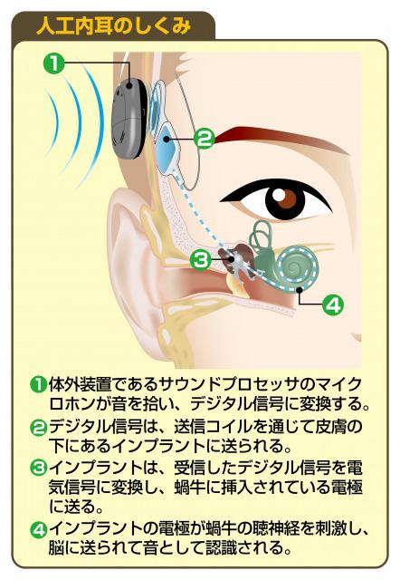 s_Hearing impaired cochlear implant4.jpg