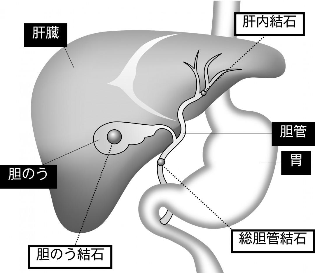 胆石 は 酢 で 溶ける