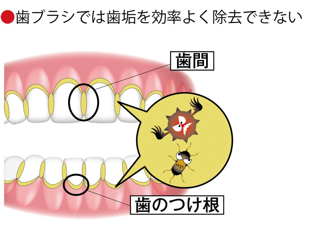 s_歯垢.jpg