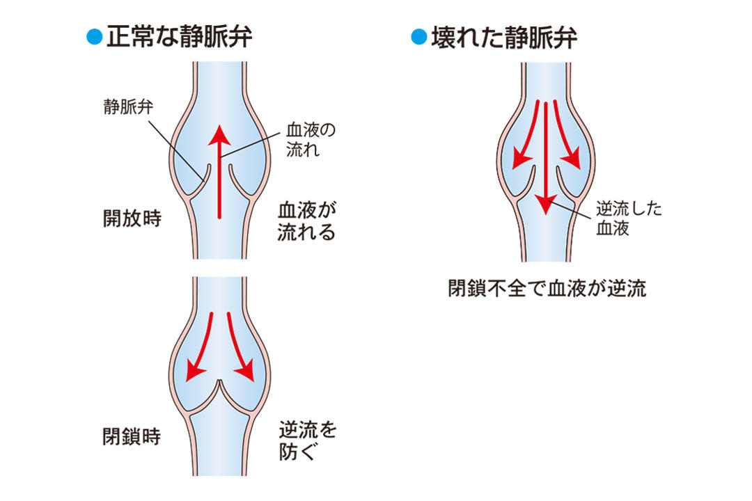 静脈弁のしくみ3.jpg