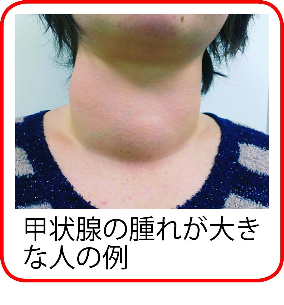 甲状腺腫れ例-1.jpg