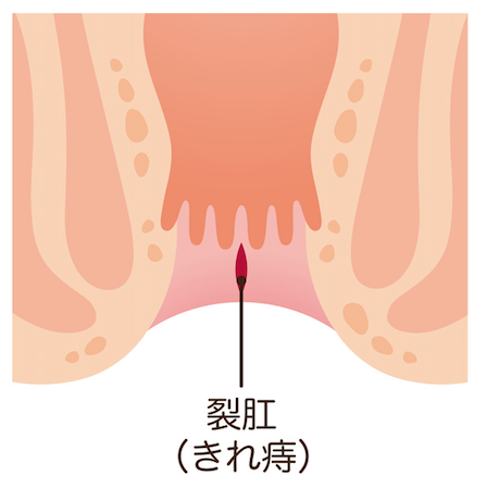 Hemorrhoid type３.png