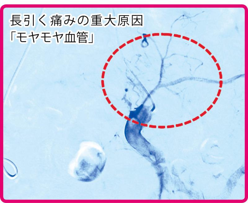 s_モヤモヤ血管　写真.jpg