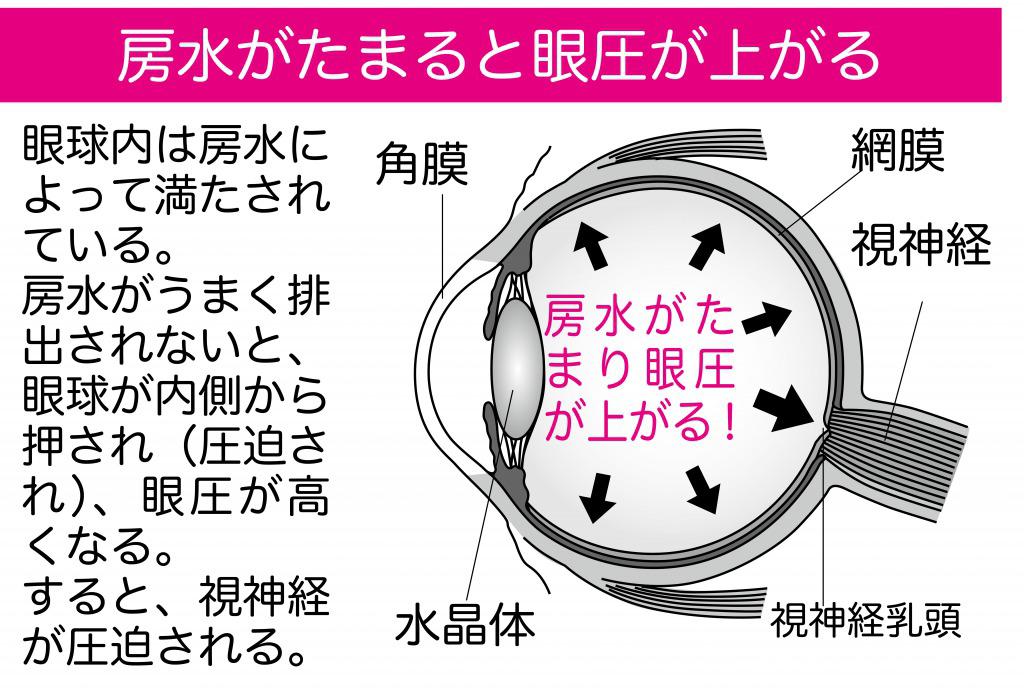 s_房水がたまると眼圧が上がる.jpg