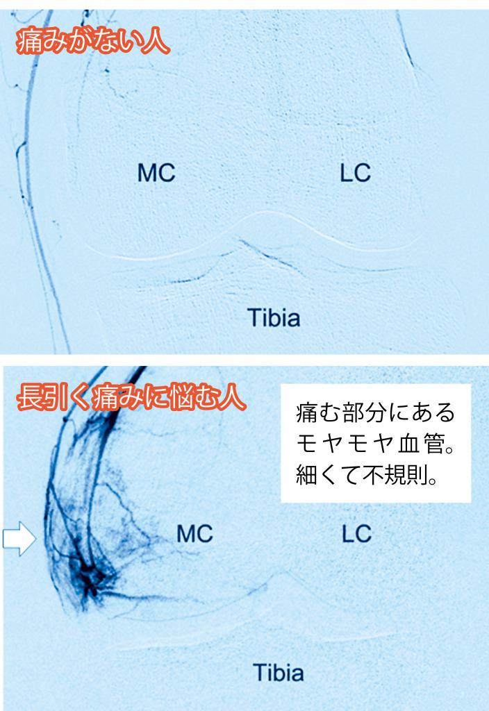 s_モヤモヤ血管２.jpg