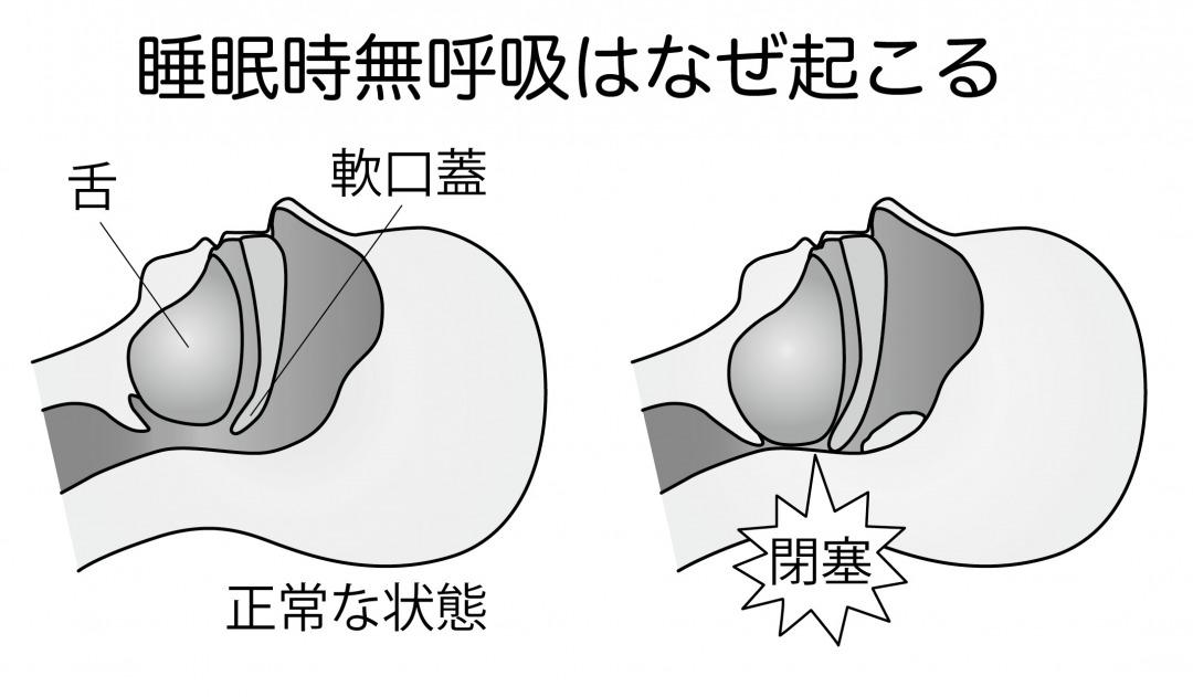 s_睡眠時無呼吸はなぜ起こる2.jpg