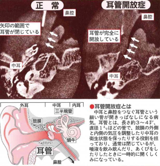 耳管開放症は治せる 治療法を医師が徹底解説 1分でよくなる新療法や手術法も網羅 カラダネ