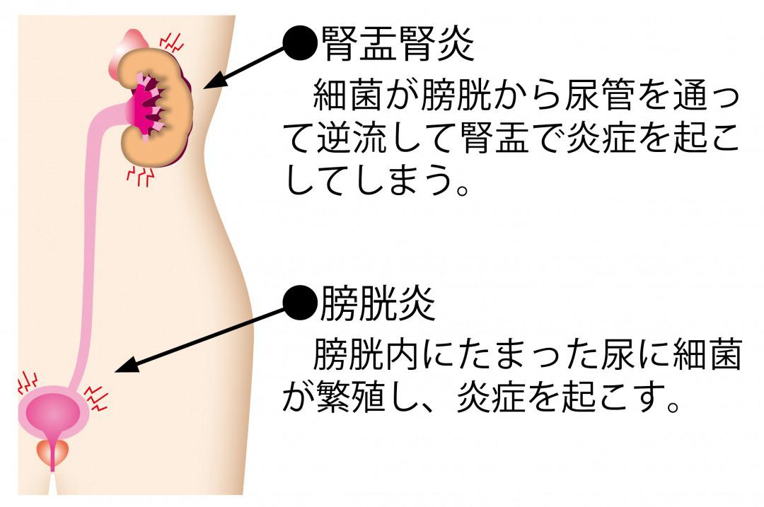 s_トイレ我慢　病気.jpg