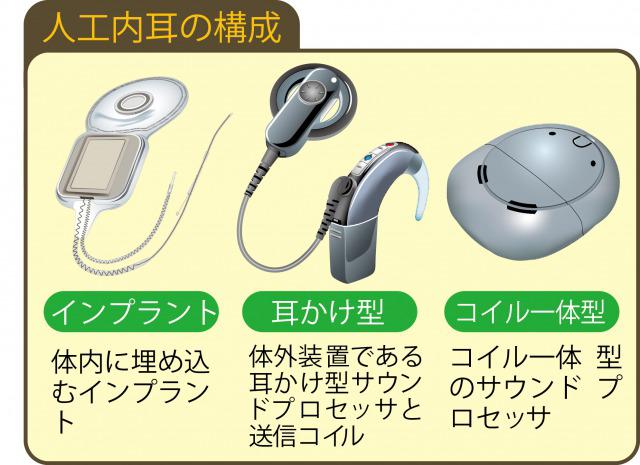 s_Hearing impaired cochlear implant書き直し.jpg