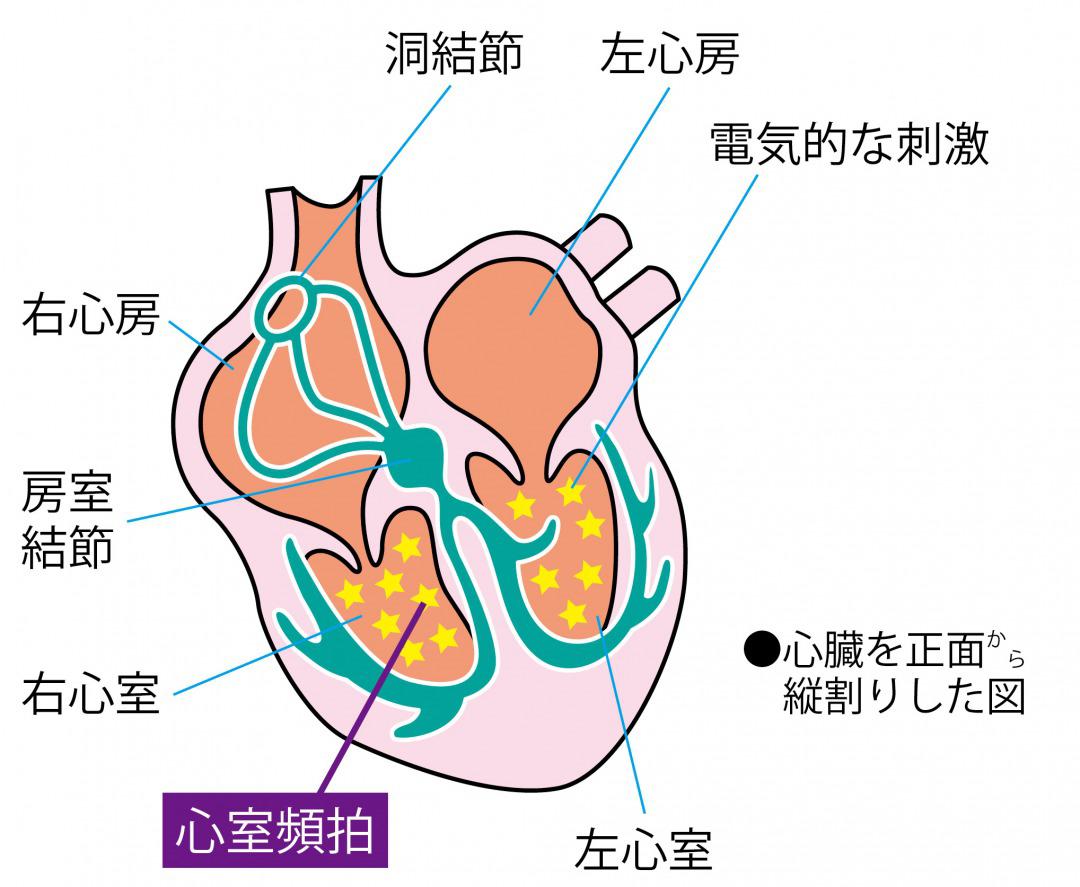 s_心室頻拍　起こるしくみ.jpg