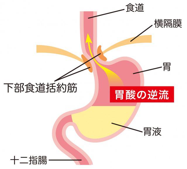 s_Reflux esophagitis２.jpg