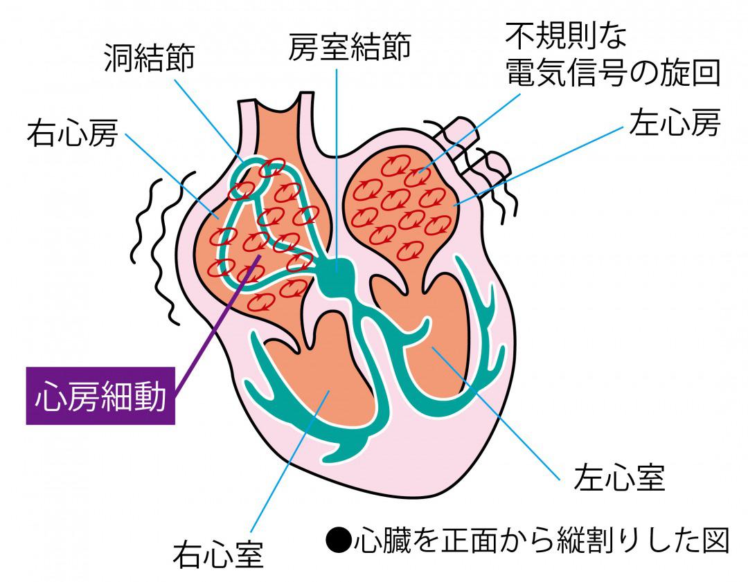 結 滞 と 不整脈 の 違い