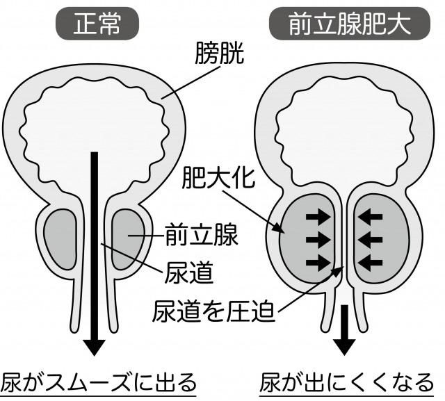 Prostatic hypertrophy.jpg