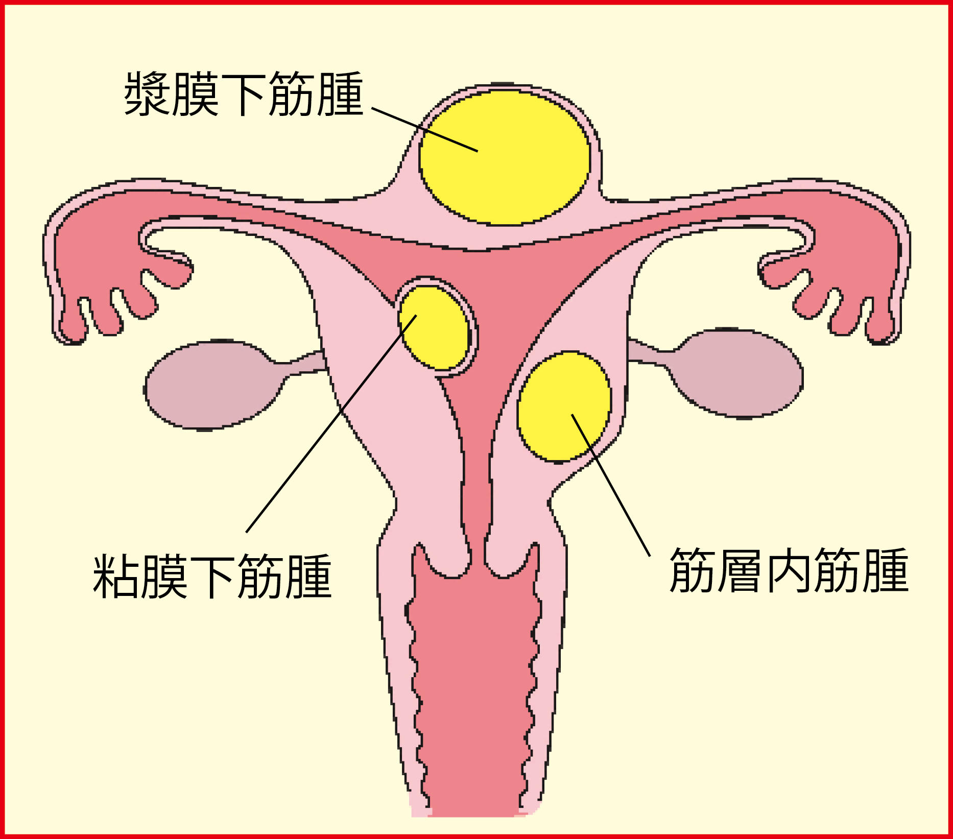 専門医が【子宮筋腫】の種類・原因・症状を解説。なんと女性の34割に見つかる｜カラダネ