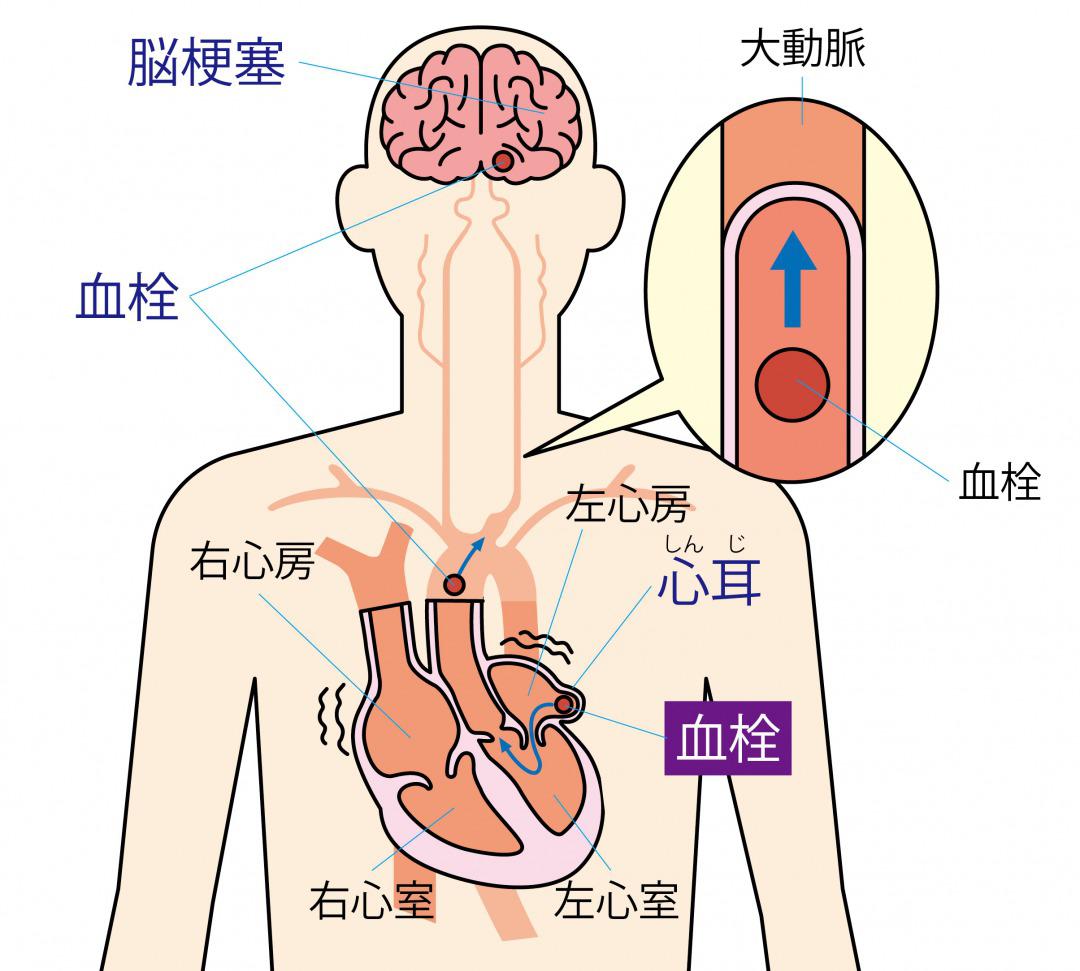 s_心房細動が原因の脳梗塞.jpg