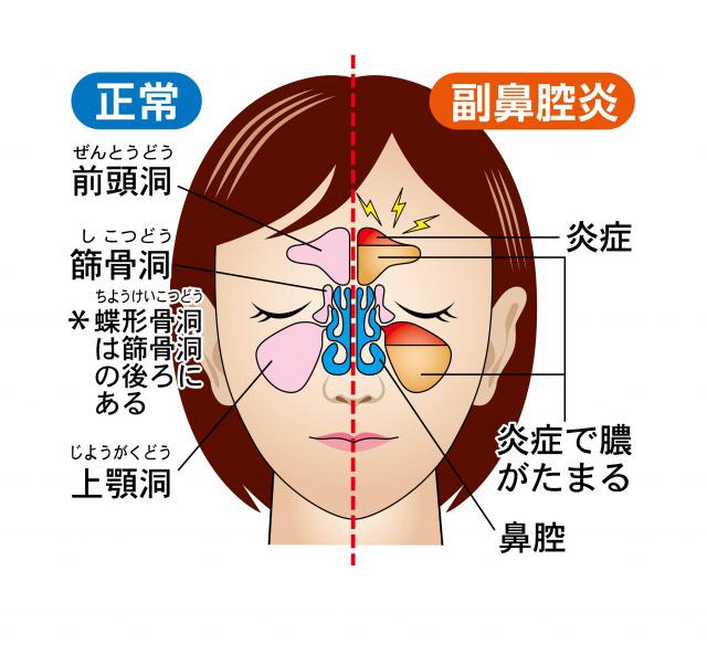 鼻水 目 の 腫れ