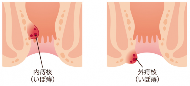 Hemorrhoid type１.png