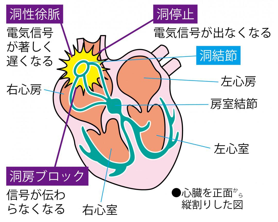 横 に なると 不整脈 が 出る