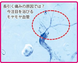 【専門医解説】モヤモヤ血管（新生血管）とは？ひざ痛など慢性痛の原因？治し方は？