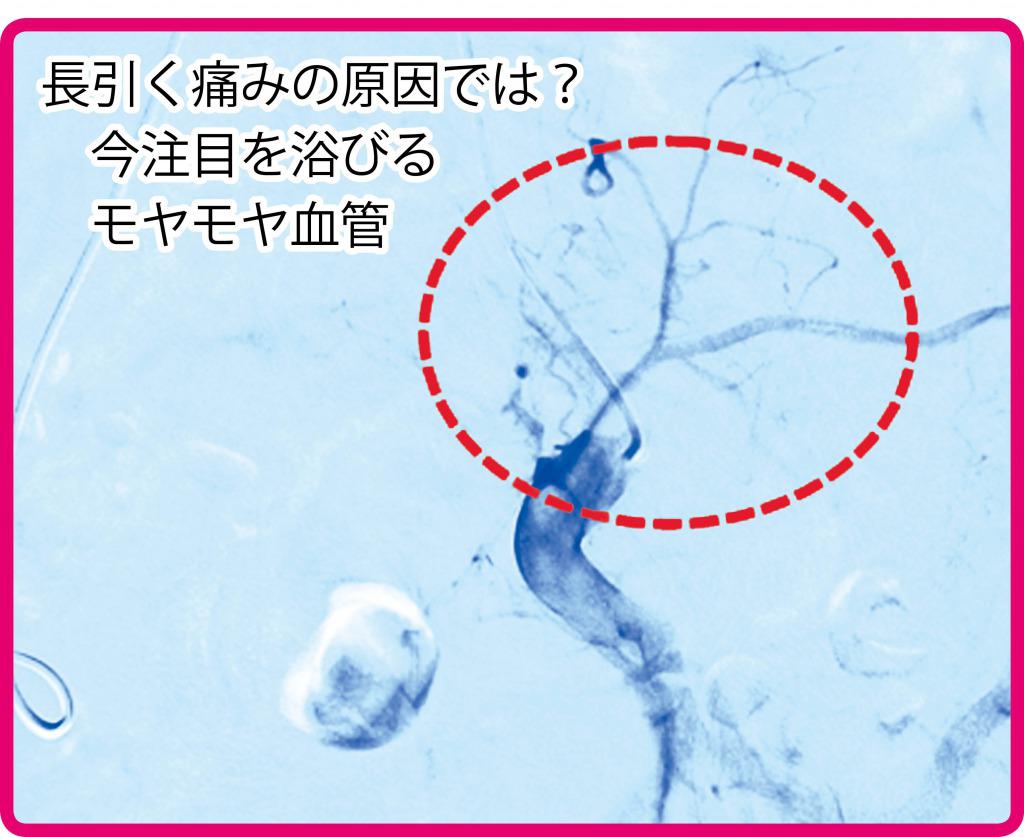 病院リストつき モヤモヤ血管を減らし長引く痛みを消す カテーテル治療 とは 費用は 全解説 カラダネ