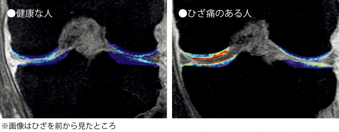 s_MRI　プロテオ.jpg