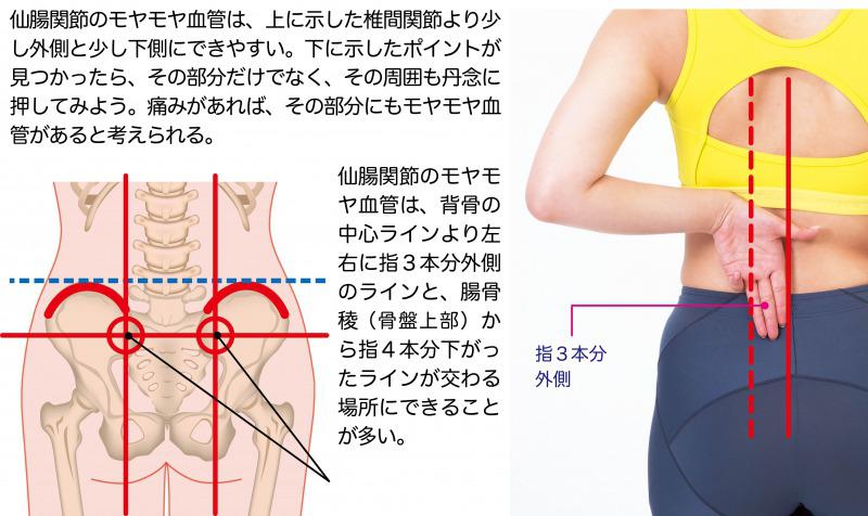 s_モヤモヤ血管の探し方　仙腸.jpg