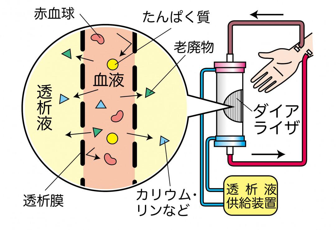 hemodialysis.jpg