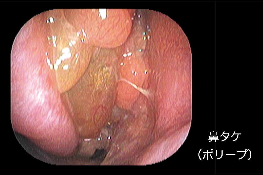 nasal-polyps.jpg