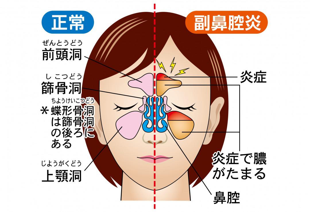 paranasal-sinus.jpg