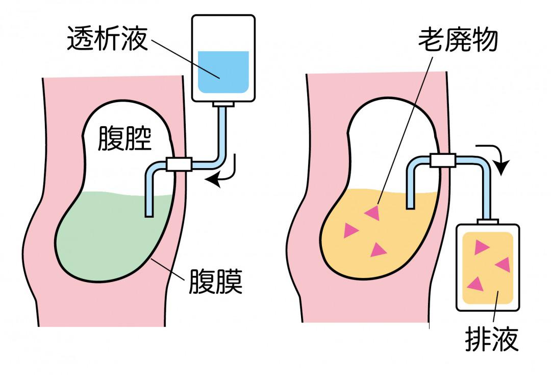 peritoneal-dialysis.jpg