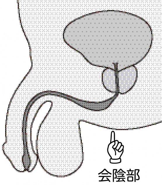 s_Male urinary leak (1).jpg
