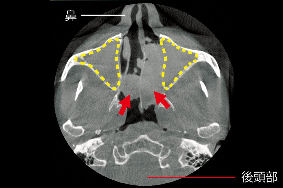 sinusitis-ct.jpg